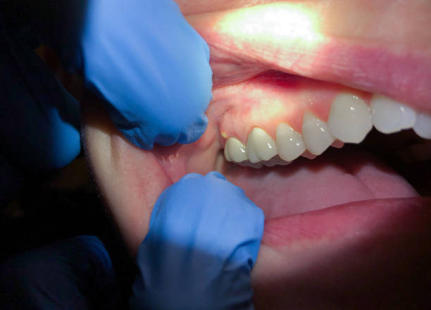 Best Emergency Denture Repair in Chester, NY